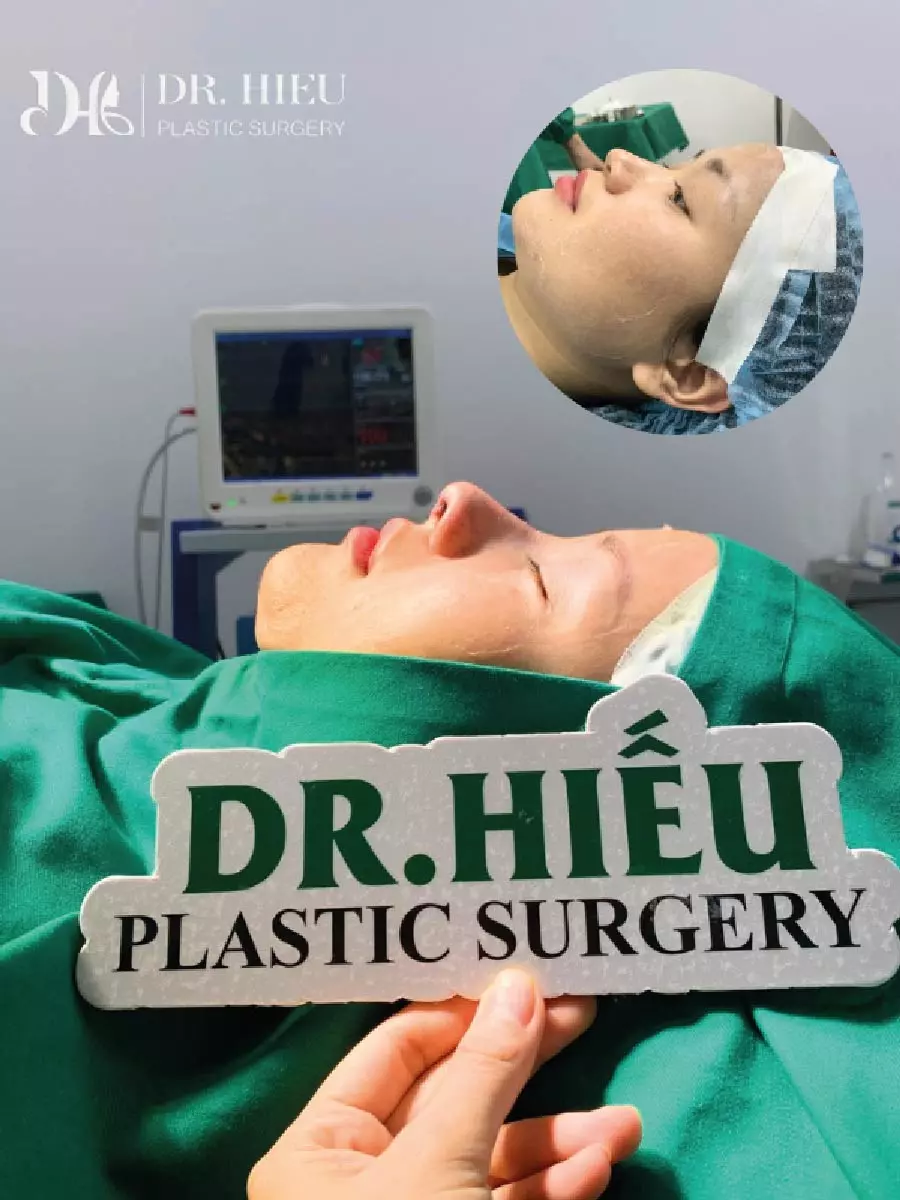 Hình ảnh thực tế nâng mũi (1)