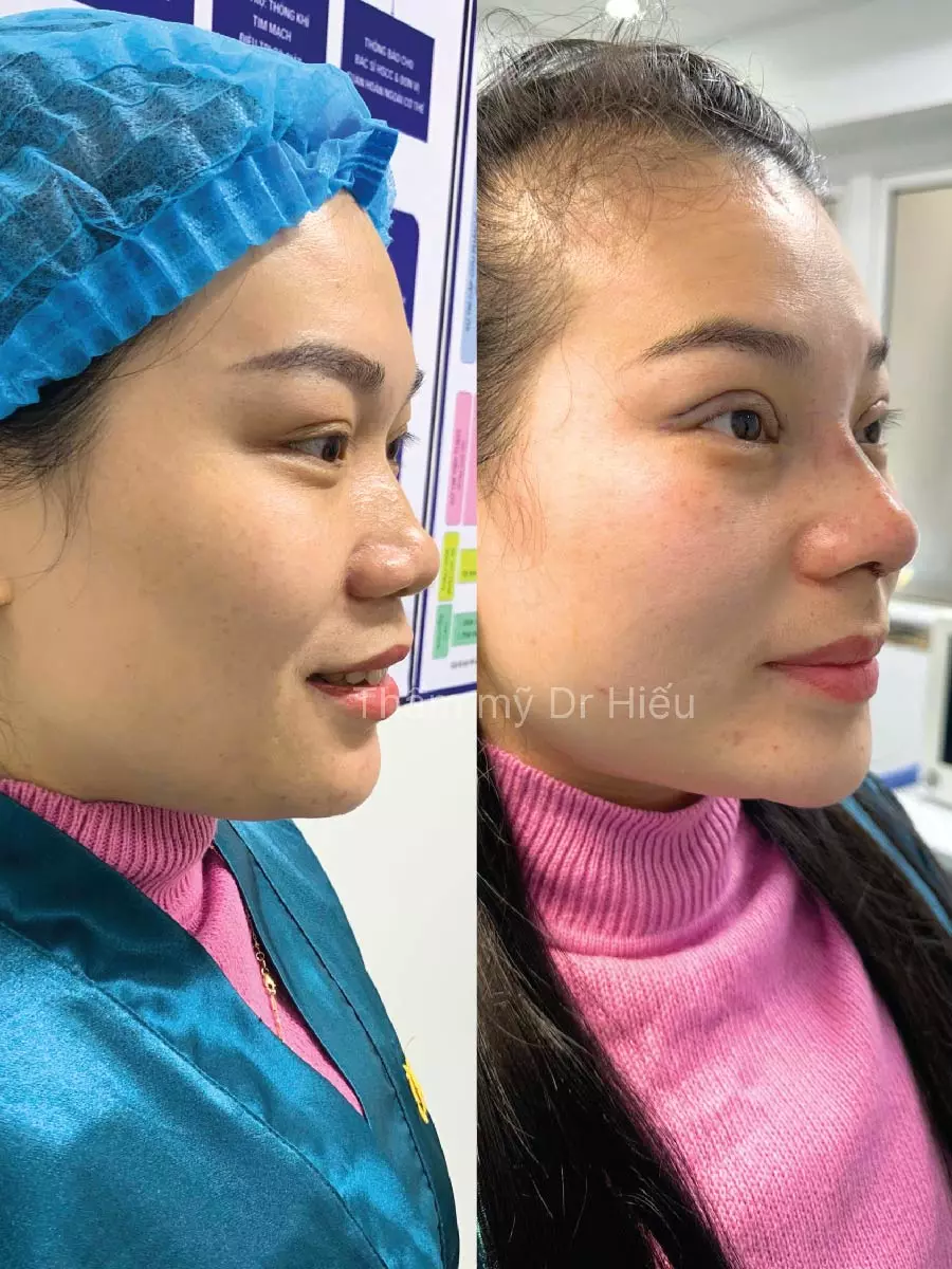 Hình ảnh thực tế nâng mũi (3)
