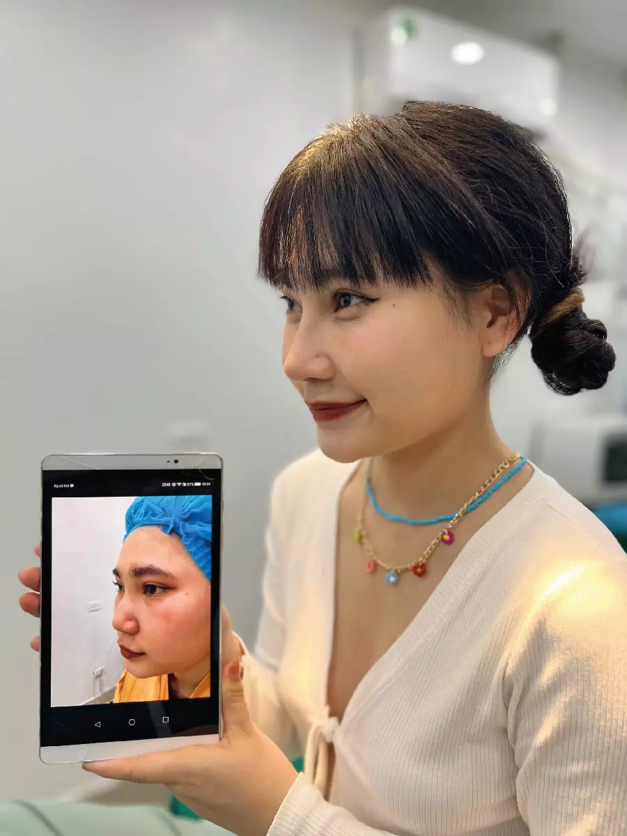 Hình ảnh thực tế nâng mũi (4)