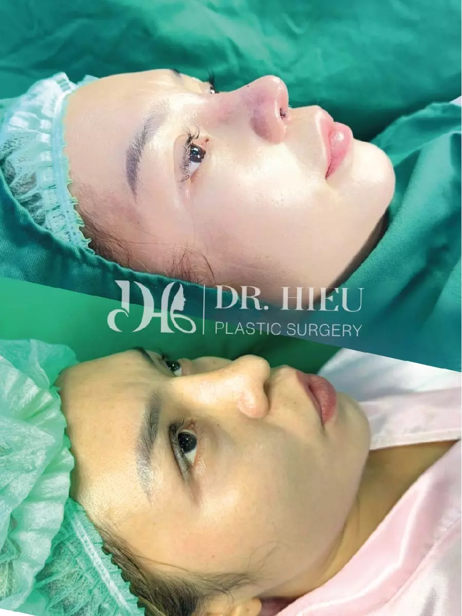 Hình ảnh thực tế nâng mũi (5)
