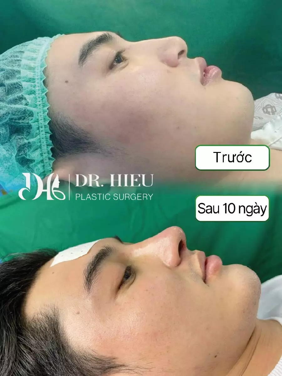 Hình ảnh thực tế nâng mũi (6)