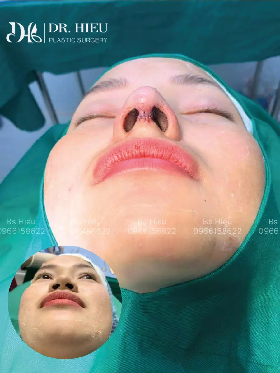 Hình ảnh thực tế nâng mũi (7)