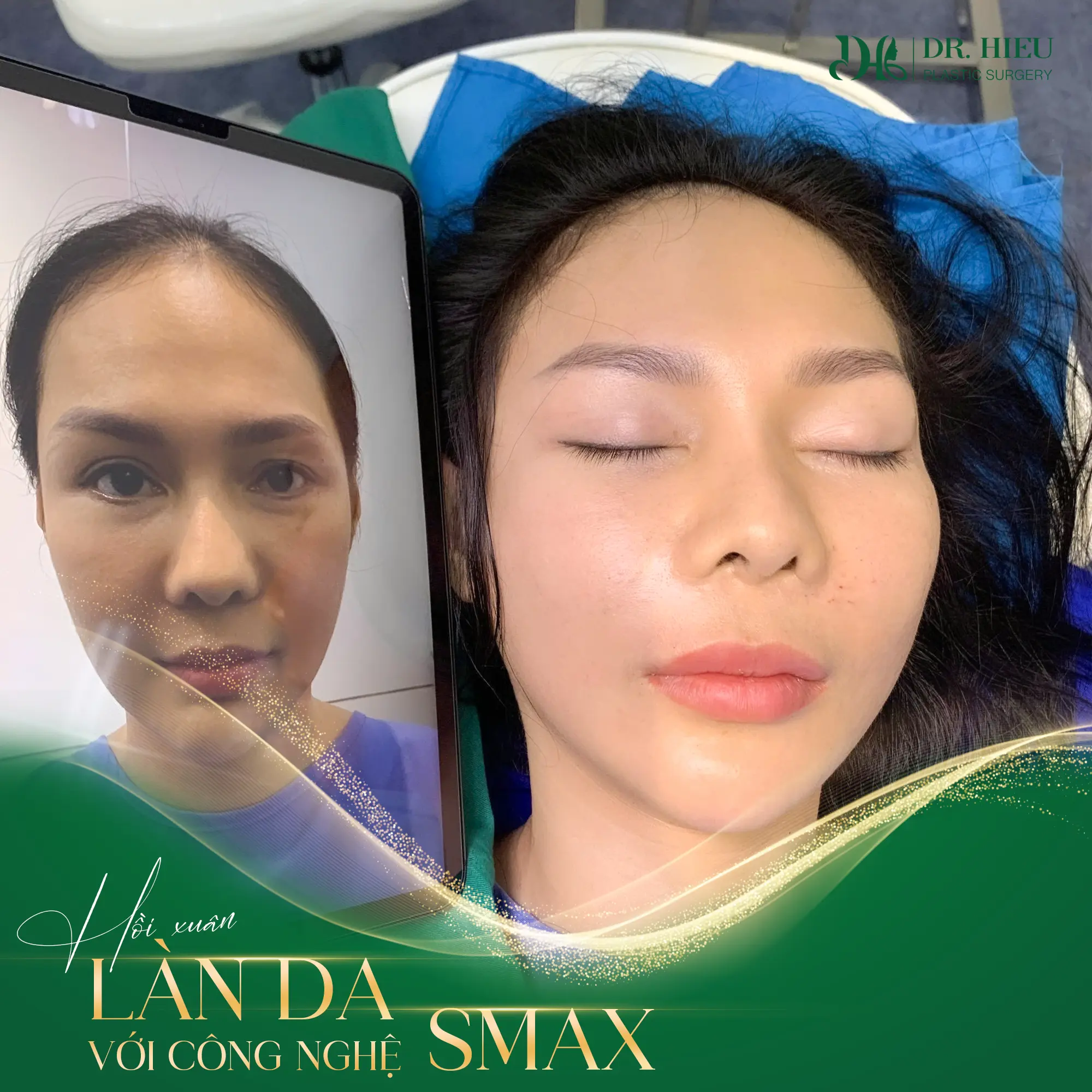 Hồi xuân làn da với công nghệ Smax (2)