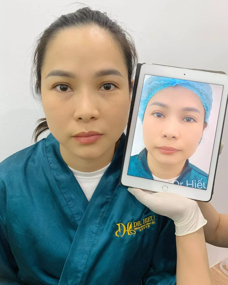 Căng Da Siết Cơ Nội Soi1