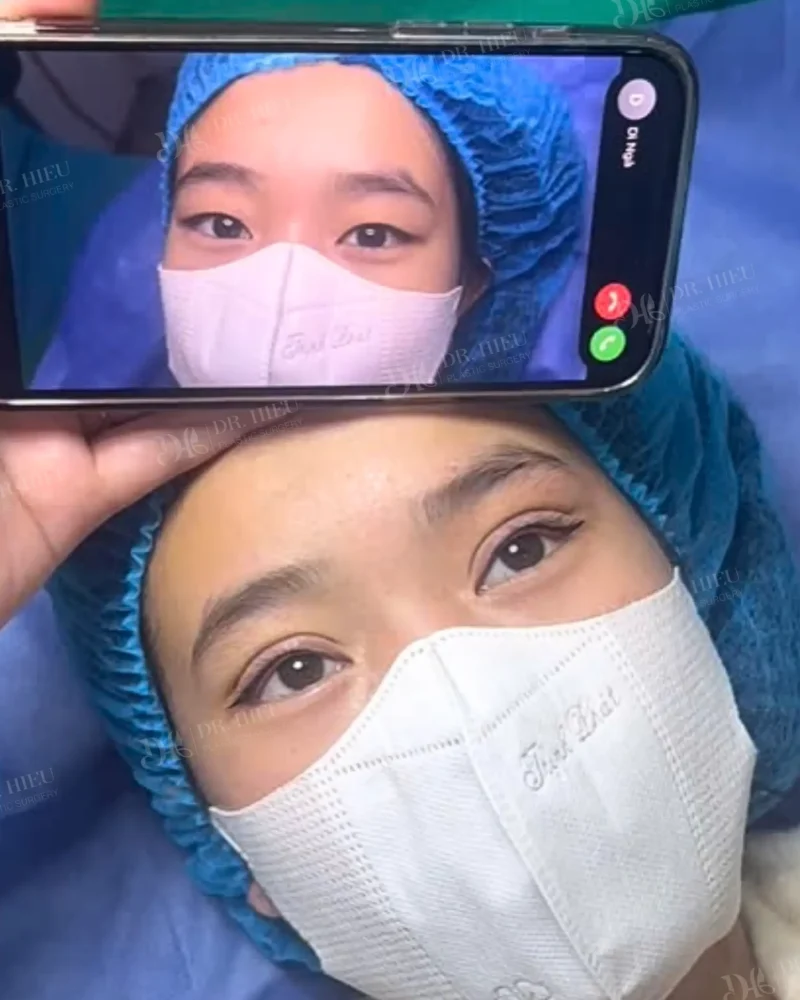 cắt mí (3)