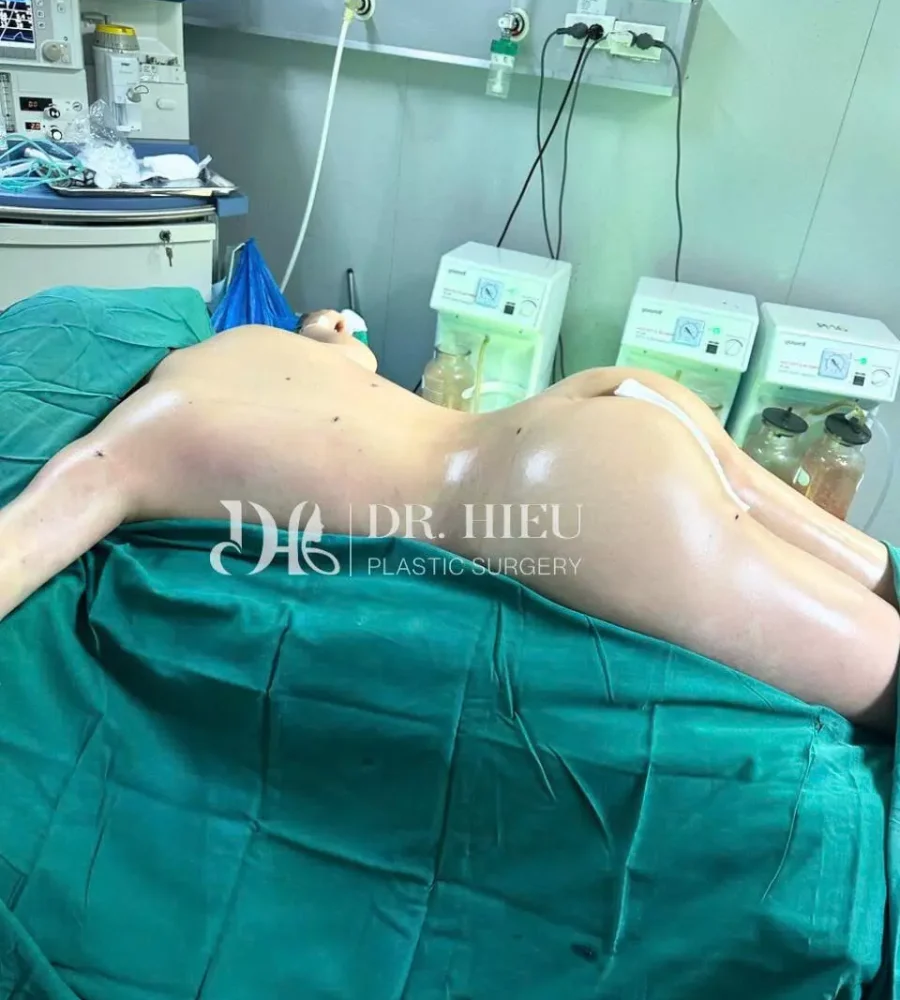 cấy mỡ (4)
