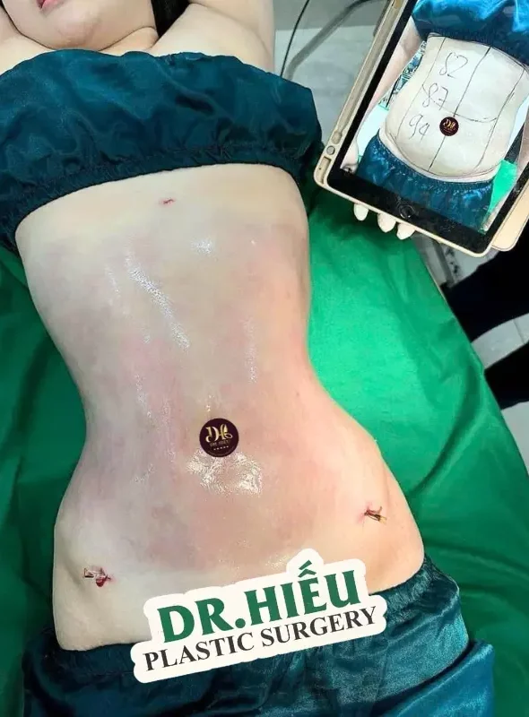 hút mỡ bụng (6)