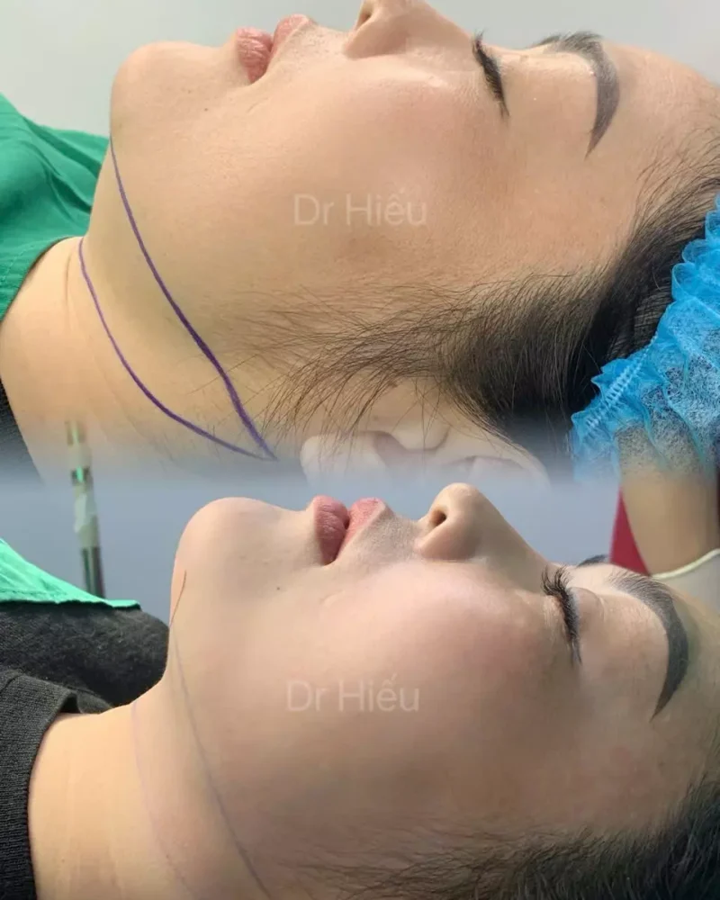 hút mỡ nọng hàm1